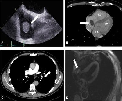 Case Report: Right atrial mass arising from the Eustachian valve